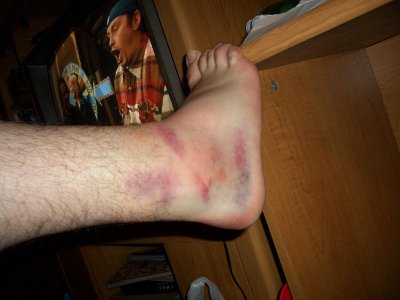 my ankle 005 revised.JPG
